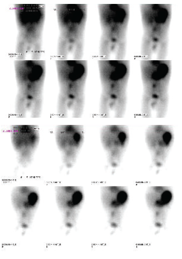 An Infant’s Episode of Bright Bloody Stool | Consultant360